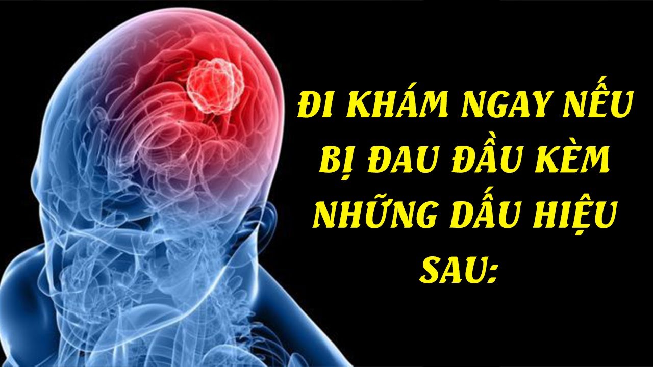 Bệnh đau đầu | Triệu chứng của cơn đau đầu RẤT NGUY HIỂM không được chủ quan| TS.BS Đinh Vinh Quang