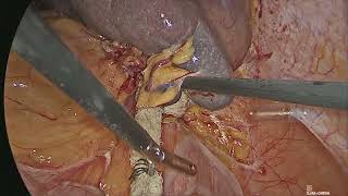Download Lagu LAPAROSCOPIC PANCREATOSPLENECTOMY(RAMPS)FOR ANUERYSM OF SPLENIC ARTERY MP3 Download Lagu LAPAROSCOPIC PANCREATOSPLENECTOMY(RAMPS)FOR ANUERYSM OF SPLENIC ARTERY MP3