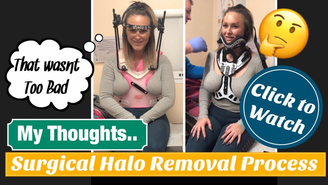 Post Surgical Halo Removal Thoughts YouTube