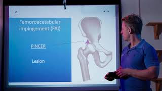 Hip Joint Pathologies causing back, groin, buttock, & knee pain