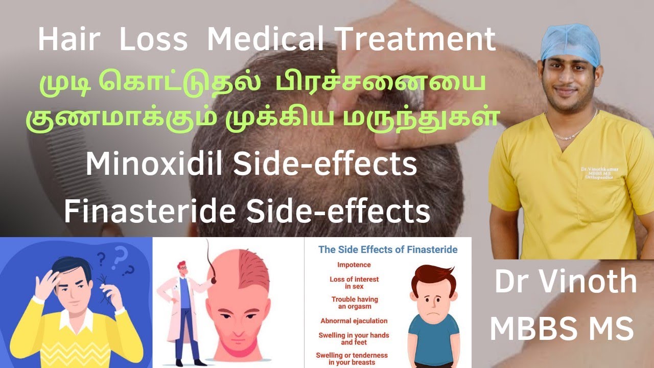 தலைமுடி உதிர்தல் பிரச்சனை|Male pattern Baldness|Androgenic alopecia treatment|Minoxidil|Finasteride