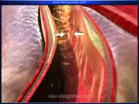 atherosclerosis interactive video