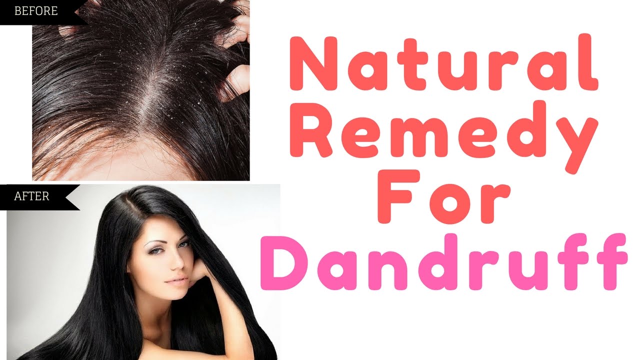 Miracle Natural and Home Remedy For Dandruff & Hair Regrowth Top 10