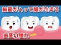 歯ぐきがぶよぶよに腫れている‼︎Gum Swelling Due To Periodontal Disease