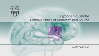Embolic Stroke Of Undetermined Source Esuscryptogenic Stroke By Deena M. Nasr, Do Preview