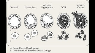 Atypical ductal hyperplasia ADH and Atypical lobular hyperplasia ALH Of the Breast; Causes, Symptom
