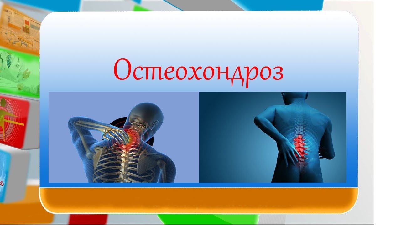 Остеохондроз лечение схема, симптомы, диагностика, препараты. - YouTube