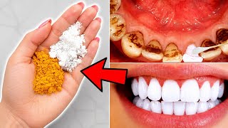 Teeth Whitening Remedy | How to Whiten Yellow Teeth? पीले दांतों को मोती जैसे चमकाएं #teethwhitening