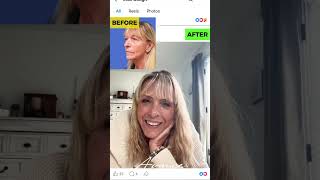 Before & After Rhinoplasty, Facelift, & Upper Blepharoplasty | Avance Plastic Surgery Institute