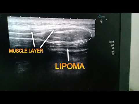 inter/intramascular lipoma ultrasound video