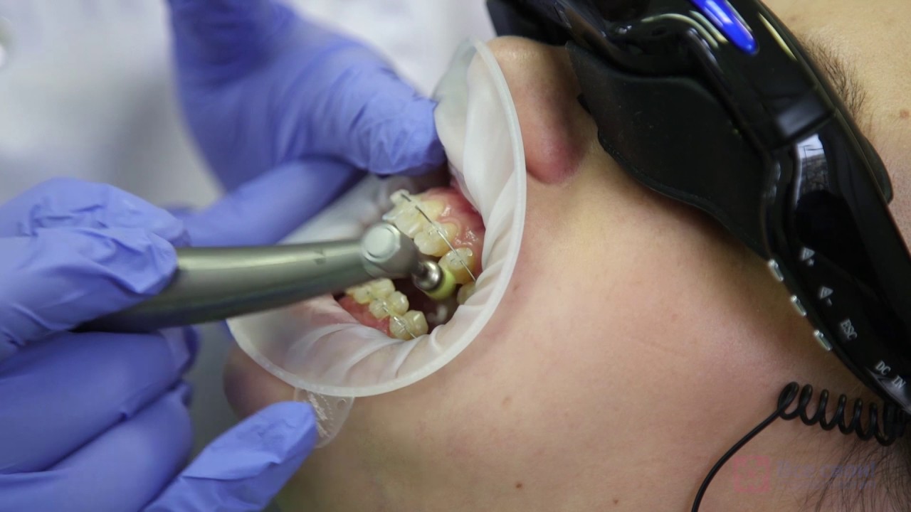 Как проводят профессиональную чистку зубов с брекетами