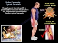 Spine Concepts , Lumbar Spinal Stenosis - Everything You Need To Know - Dr. Nabil Ebraheim