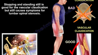 Lumbar Spinal Stenosis - Everything You Need To Know - Dr. Nabil Ebraheim