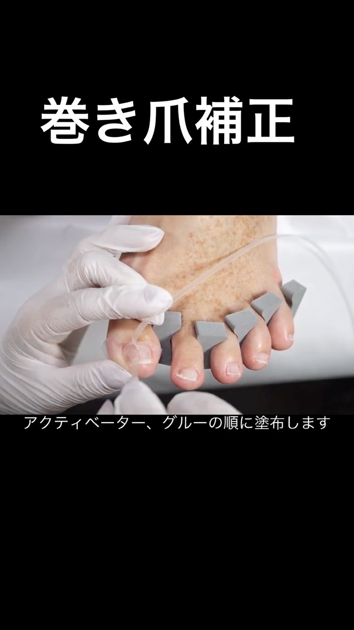 巻き爪ケアフレックスプレート装着方法 - YouTube