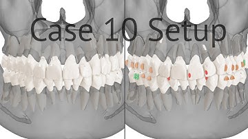 Maestro 3D aligners virtual setup: case 10, crowding, solved with upper jaw distalization and IPR