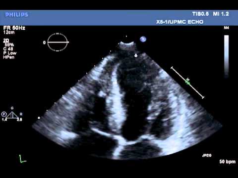 Transthoracic Echocardiographic Images Obtained after Cardiac  Catheterization 