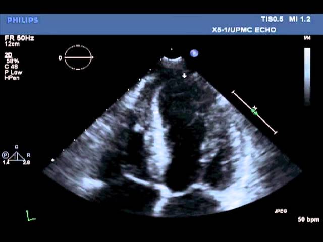 2-D echocardiography showing severe global hypokinesia and left