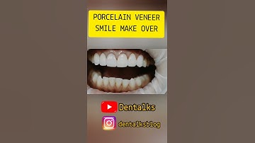 #Shorts #ShortvideoPorcelain veneer smile makeover
