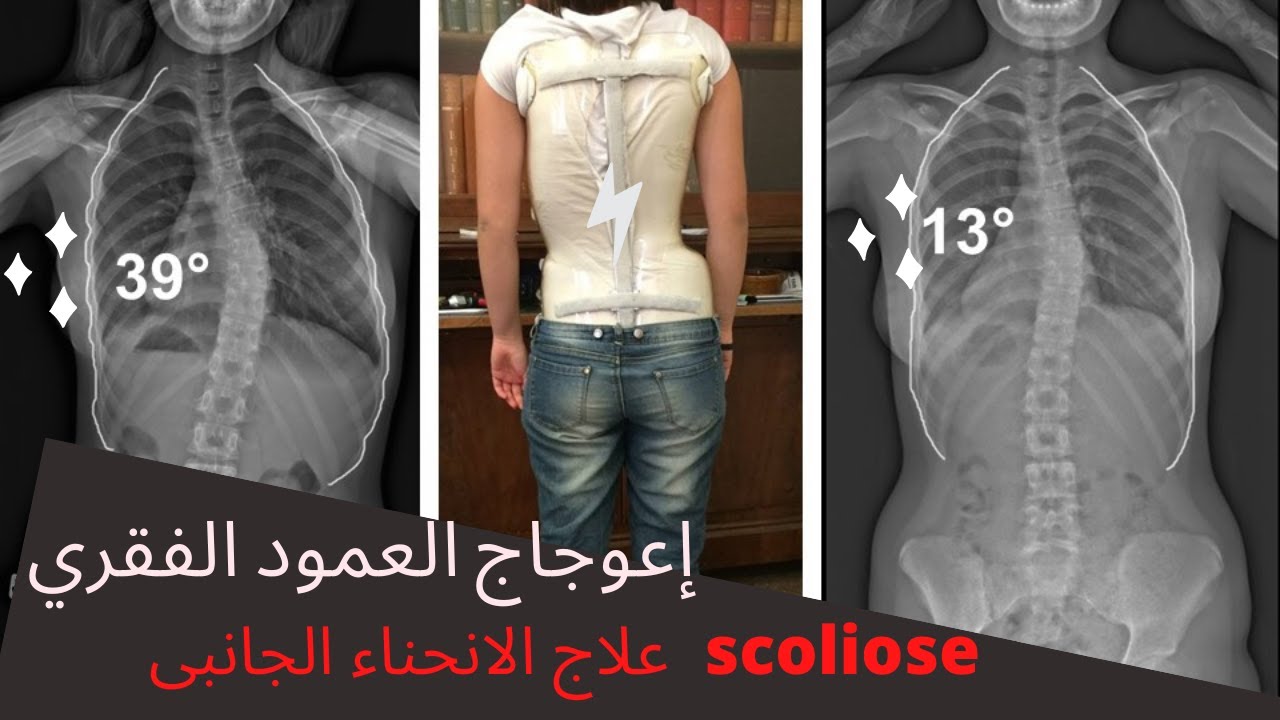 scoliose , تشخيص وعلاج الانحناء الجانبى للعمود الفقرى ...الجنف