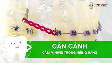 CẬN CẢNH NIỀNG RĂNG CẮM MINIVIS [Tâm Đức Smile]