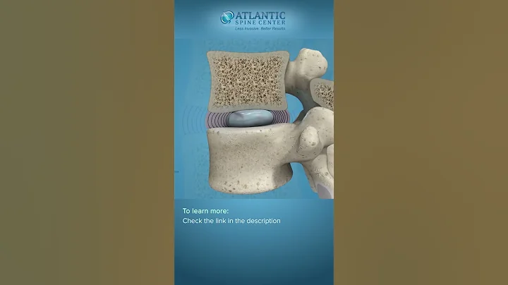 What is Spondylolisthesis? | Vertebral Slippage #Shorts - DayDayNews
