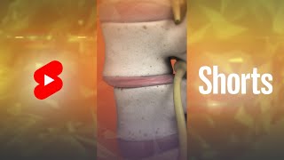 What is Spondylolisthesis? | Vertebral Slippage #Shorts