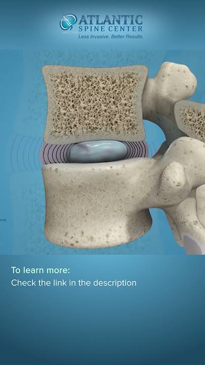 What is Spondylolisthesis? | Vertebral Slippage #Shorts