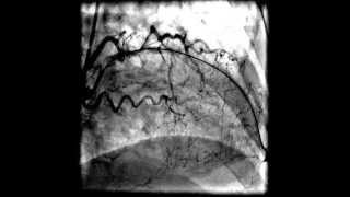Коронарное стентирование (видео). Стентирование ПМЖВ(Стентирование передней межжелудочковой ветви (ПМЖВ) сердца на фоне острого инфаркта миокарда. В просвет..., 2015-04-07T06:27:20.000Z)