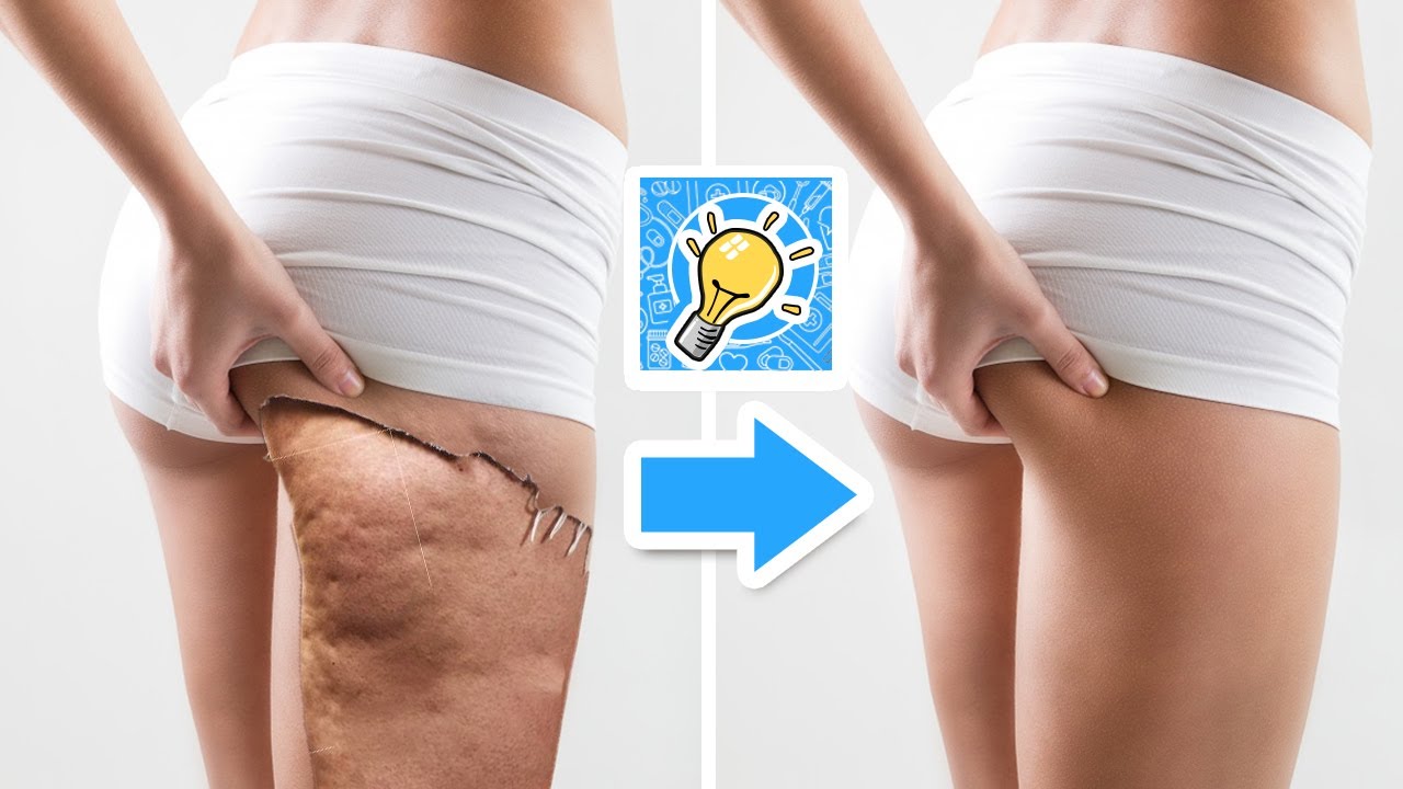 How To Get Rid Of Cellulite Naturally in 2 Weeks | Natural ...