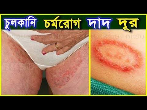 মাত্র ১ বার ব্যবহারে দাদ,চুলকানি এর মত সমস্যা দূর হবে।