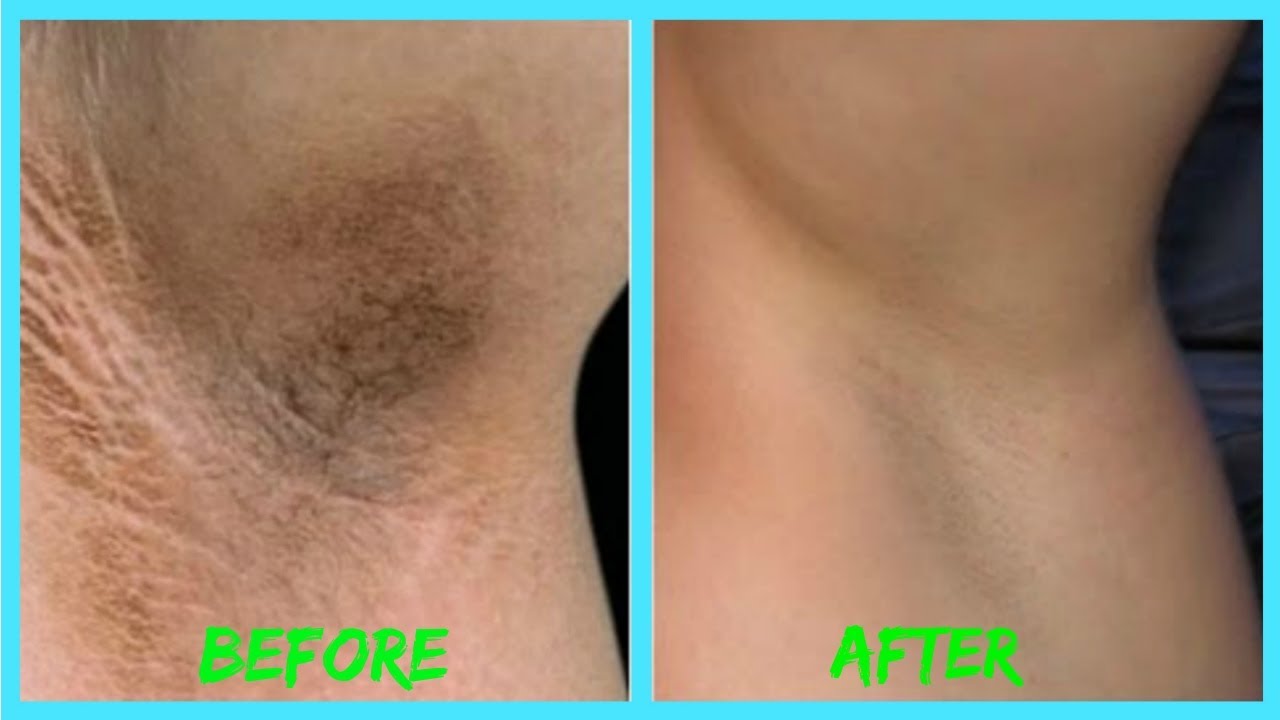 How To Get Rid Of Dark Underarms And Get Rid Of Bad Smell Best Diy