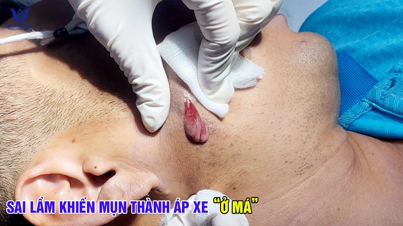 Cảnh báo mụn viêm ở má đừng để thành áp xe như thế này.