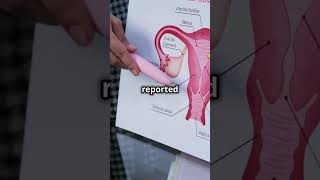 Nbcs 30M Settlement The Uterus Collector Case