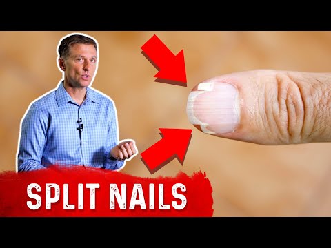 Video: Brittle Nails: Příčiny, Léčba A Prevence