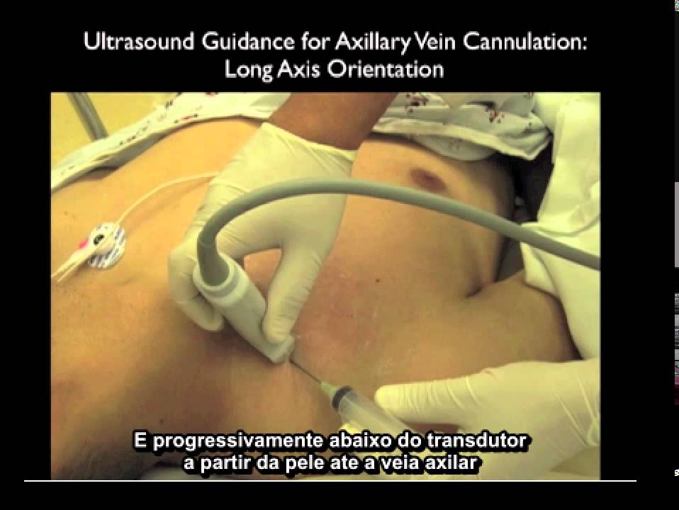 Acesso Vascular -EDU00702 Como fazer a canulação da veia axilar com uso do ultrassom