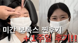 [미간 보톡스 찐후기] 시술 직후부터 1주일 후 변화까지! (풀영상)