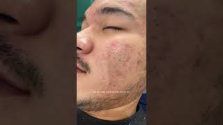 ម៉ាស្សាមុខញិចមុន បញ្ចូលវីតាមីន Pink Glow បញ្ចុះជូនពិសេស 15$  #pisong #trustmeclinic #acnetreatment