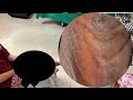 😱🦶 Jigger Gigante Extraído – Limpeza Completa dos Pés! #KL005