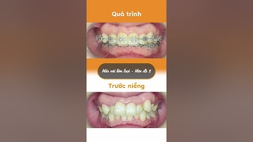 Hành trình LỘT XÁC nhờ niềng răng của Xuân Diễm
