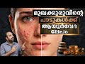 മുഖക്കുരുവും പാടുകളും മാറാൻ 3 ആയുര്‍വേദ ലേപങ്ങൾ- വീട്ടിൽ തന്നെ പരീക്ഷിക്കൂ!Get Clear Skin Naturally
