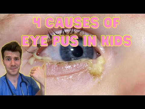 Doctor explains 4 causes of eye pus, discharge or sticky eyes in kids | Doctor O&rsquo;Donovan