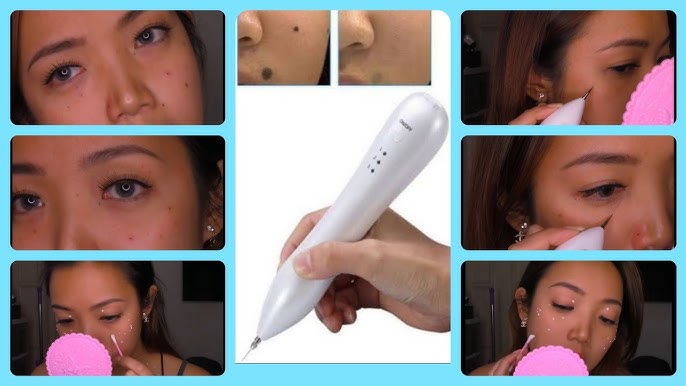 Remover pen for moles, skin tags