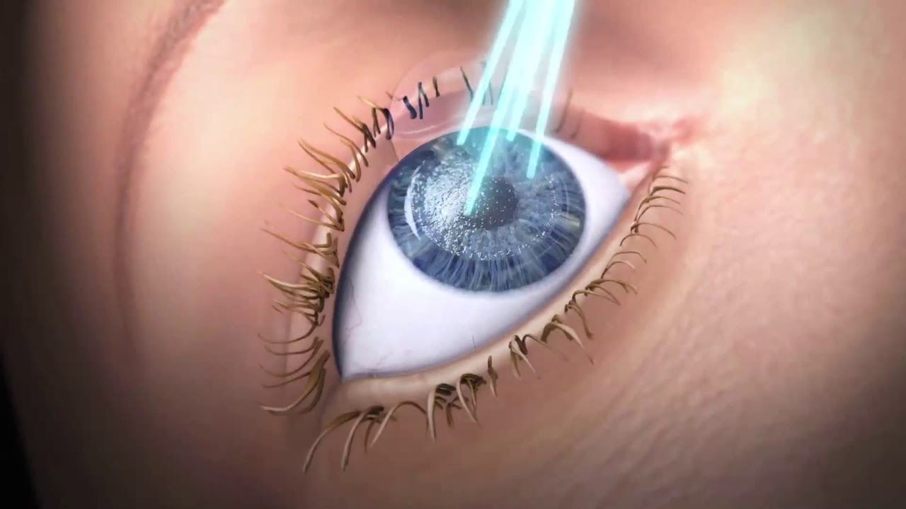 Features of SCHWIND AMARIS Excimer Laser for refractive surgery laser treatments