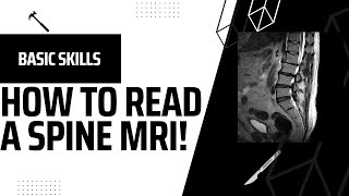 How to Read A Spine MRI