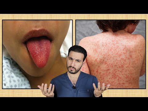 حرارة لأكثر من 5 أيام مرض كاواساكي