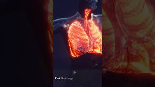 Why Lungs Crackle in Heart Failure | Pulmonary Edema Explained | RN Explains 123