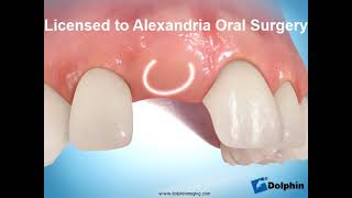 Anterior Tooth Implant 2 stage
