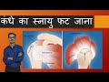 कंधे के अंदर रोटेटर कफ टीयर का इलाज  Rotator cuff Tear Hindi