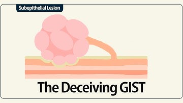 Linear EUS: The Deceiving GIST