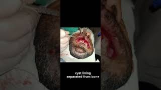 Radicular Odontogenic Cyst Health And Maxillofacial Surgeon Soulat Jehan